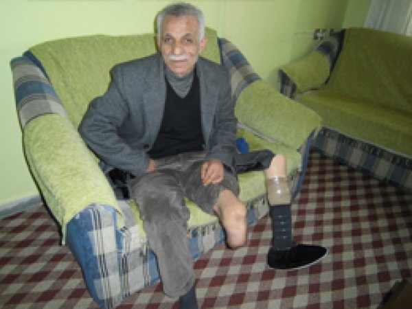 Sigara Yüzünden Bir Ayağı Kesildi 