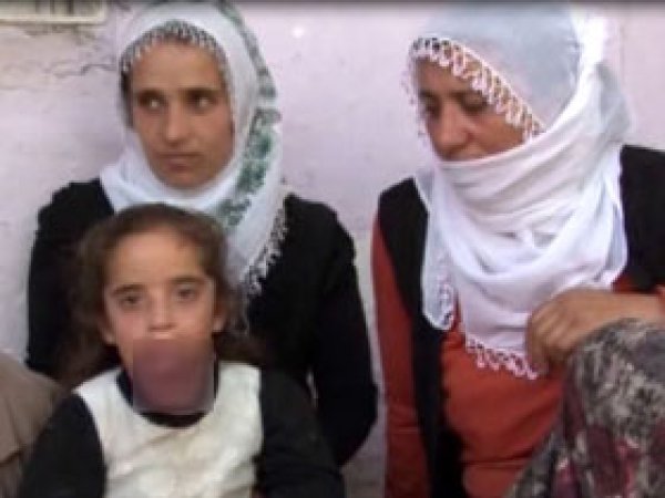 Dili Büyüyen Rozelin Yardım Bekliyor 