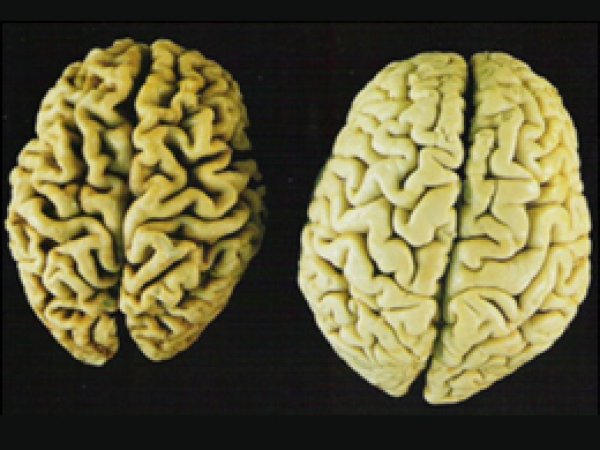 Alzheimer Hastalığında Erken Tanı Önemlidir 