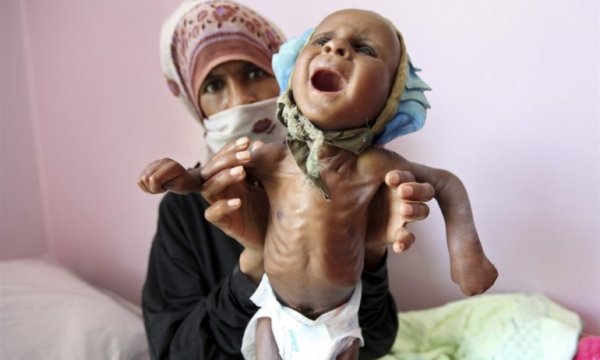 Milyonlarca Yemenli çocuğu toplu ölüm tehlikesi bekliyor 