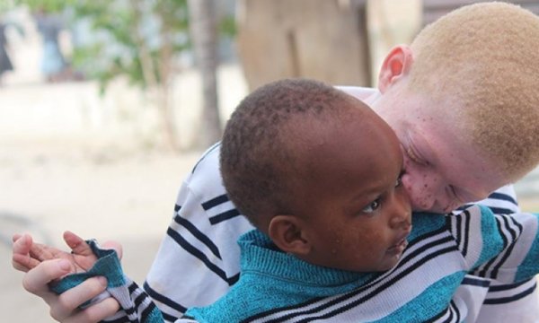 Afrikalı albinolar 'beyaz' bir gelecek ümidiyle yaşıyor