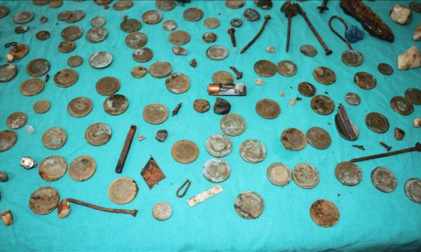Midesinden 233 parça yabancı cisim çıkarılan hasta sağlığına kavuştu