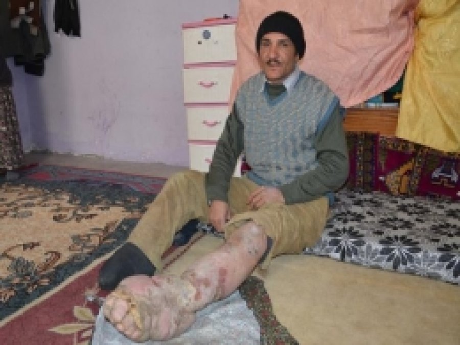 Fil Hastalığına Yakalanan Adamın Hazin Öyküsü