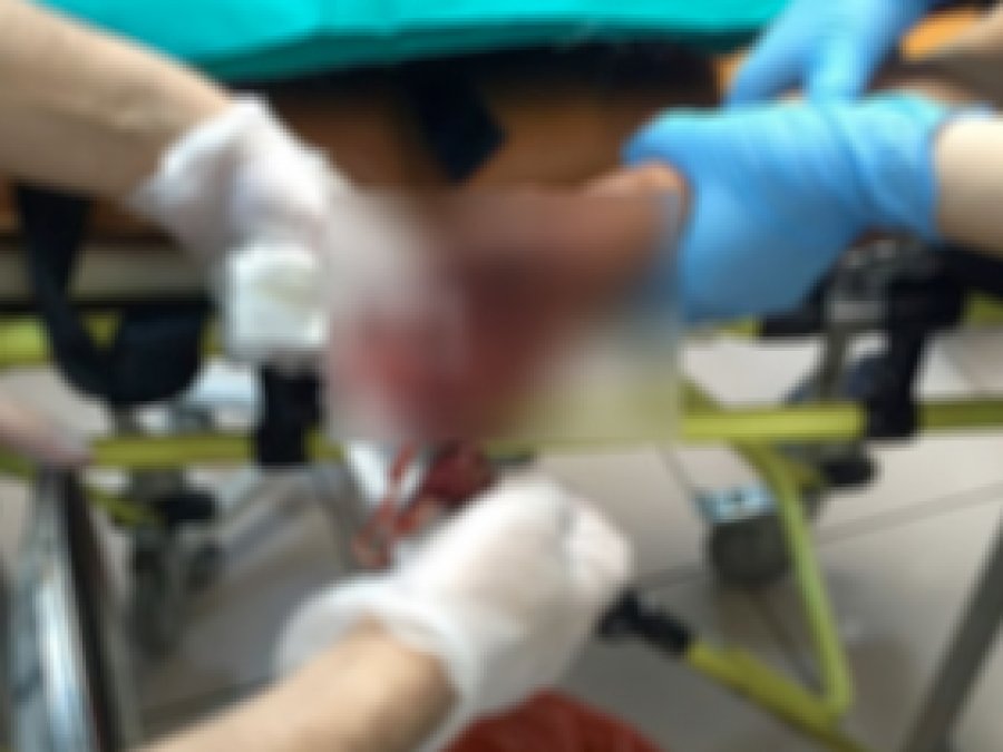 Elinde torpil patlayan çocuğun eli koptu