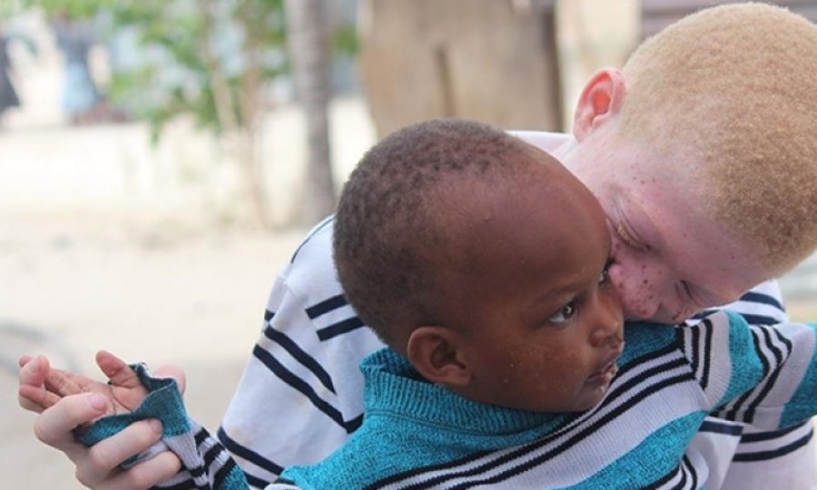 Afrikalı albinolar 'beyaz' bir gelecek ümidiyle yaşıyor